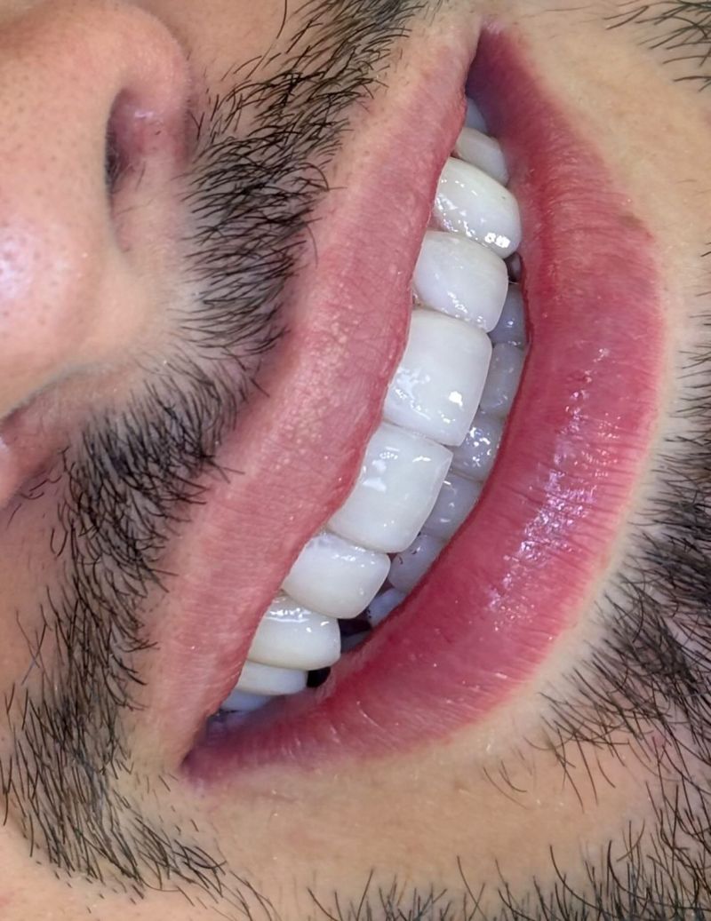 Después — Diseño de sonrisa 1
