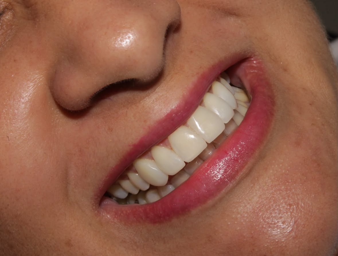 Después — Diseño de sonrisa 6