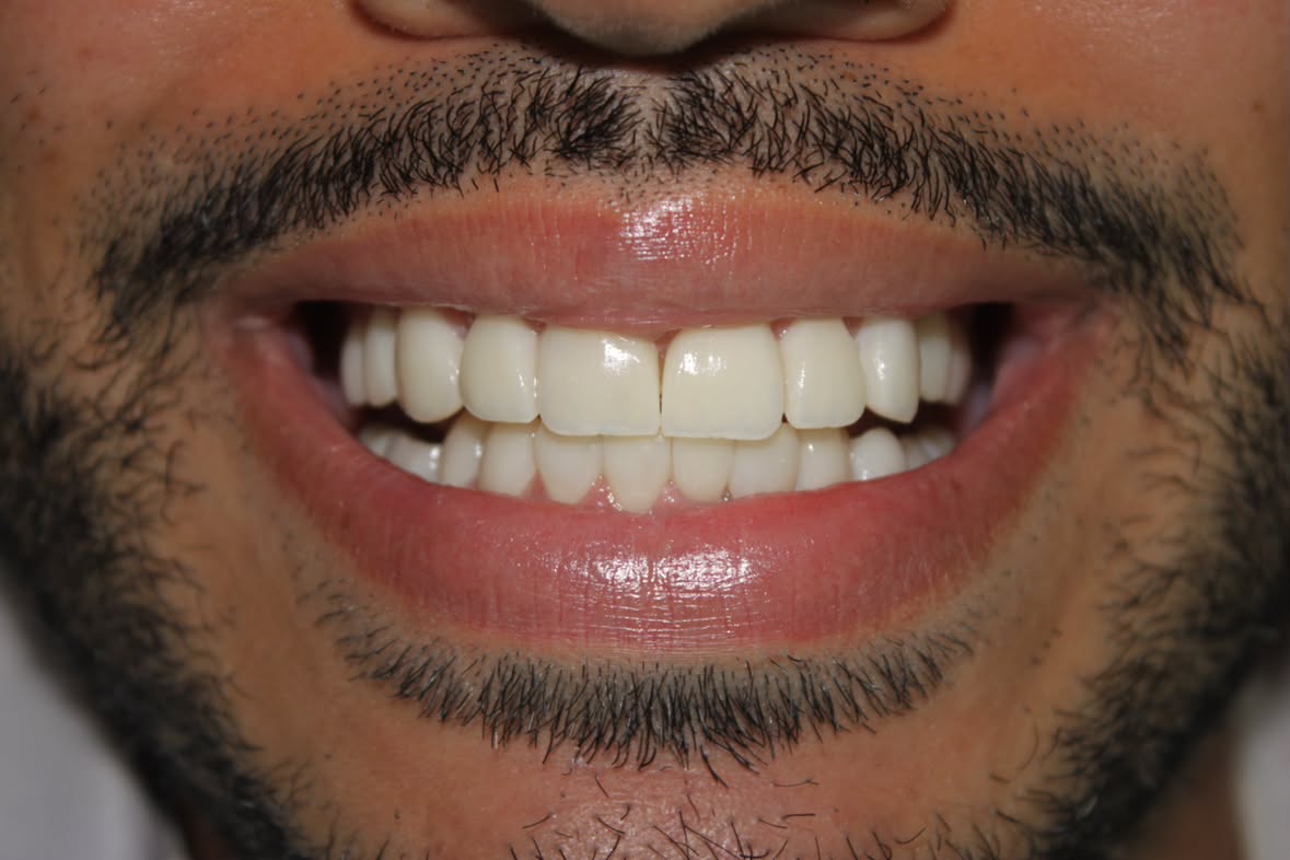 Después — Diseño de sonrisa 7